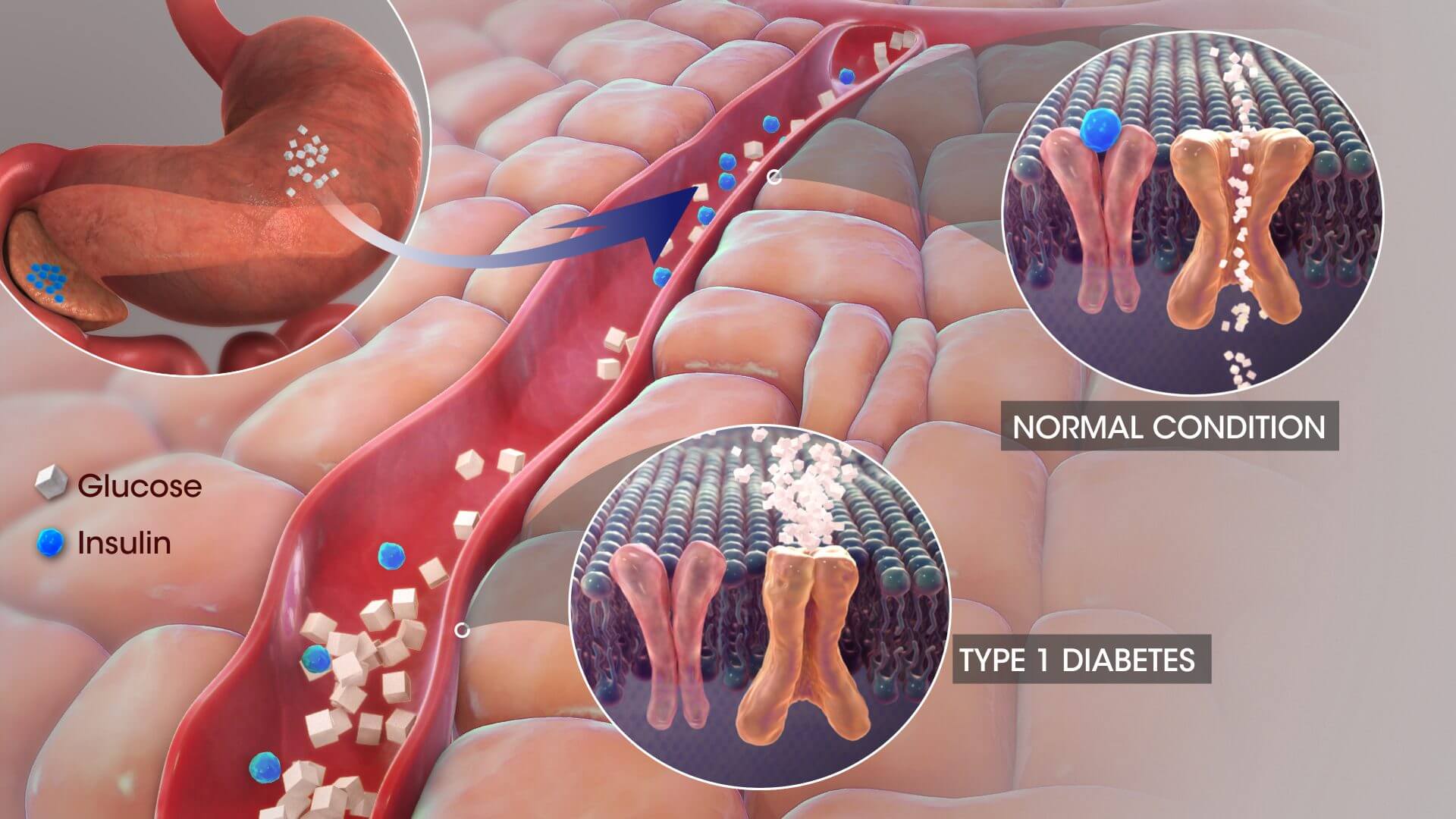diabete